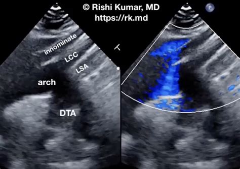 Suprasternal Aortic Arch Ultrasound View | RK.MD