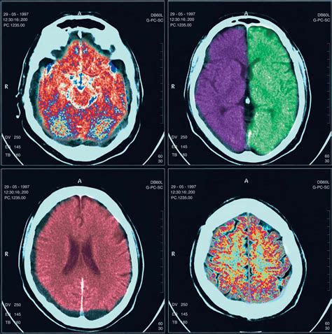 Eeg Brain Scan