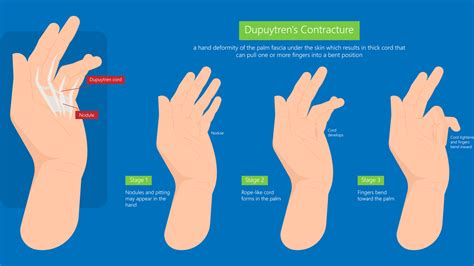 Dupuytren's Contracture Symptoms, Causes & Treatments | Advanced ...