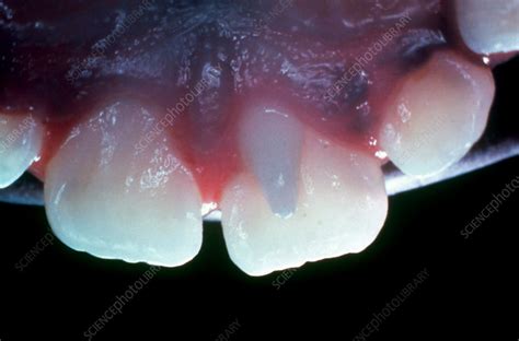 Talon Cusp on Incisor - Stock Image - C039/3034 - Science Photo Library