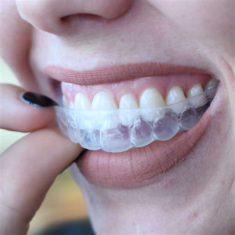 Teeth Treat: Teeth whitening at home with trays