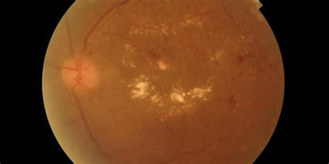 What a diabetic needs to know about Diabetic Macular Edema |Neoretina