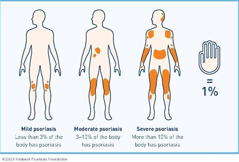 Why treat psoriasis?