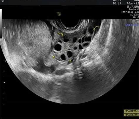 The ultrasound diagnosis of ovarian torsion [May 2021] – EFSUMB