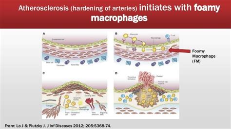 Atherosclerosis: New Insights on Foamy Macrophage Induction and Persi…