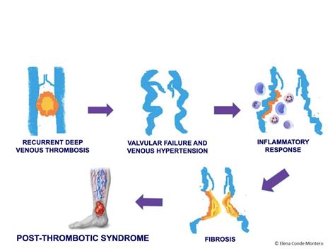 POST-THROMBOTIC SYNDROME - Elena Conde