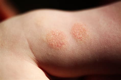 Eczema in Kids: What Parents Can Do to Calm the Itch | For Parents | US ...