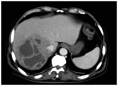 What Is The Icd 10 Code For Rectal Sigmoid Abscess