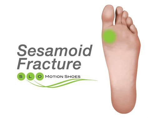 Sesamoid-Fracture - SLO Motion ShoesSLO Motion Shoes