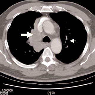 Chest X-ray shows right suprahilar tumor (thick arrow) and... | Download Scientific Diagram