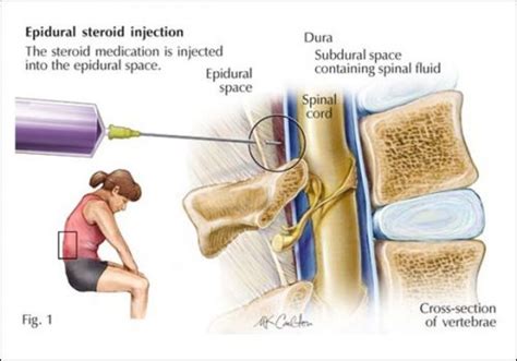 Backache | Varicose veins | Vascular surgeon | Stroke | DVT | Leg ...