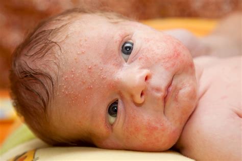 Common Baby Rashes & Newborn Skin Conditions - Baby Hints and Tips