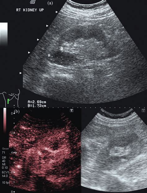 Prominent renal pyramid: a) Grey scale ultrasound demonstrated a... | Download Scientific Diagram