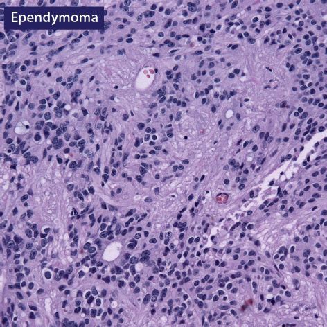 Clinical Pathology Glossary: Ependymoma | ditki medical & biological sciences