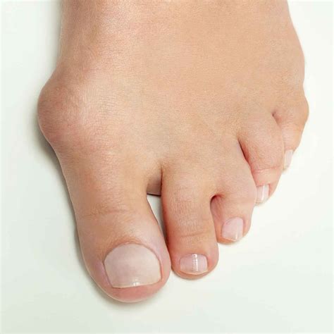 What is a Bunion? | Common Bunion Symptoms & Causes | ReadyPatient