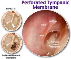 Oto-endoscopy : Fluid behind the Ear drum / Middle Ear Effusion / Glue Ear