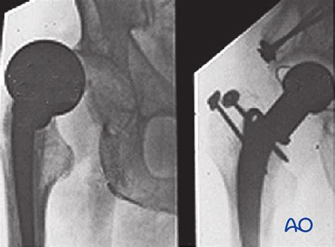 Total hip arthroplasty for Displaced subcapital femoral neck fractures