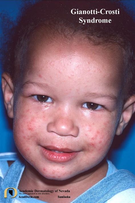 Gianotti-Crosti Syndrome: Papular Acrodermatitis of Childhood... - Academic Dermatology of Nevada