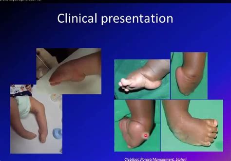 Congenital Talipes Equinovarus/Clubfoot — OrthopaedicPrinciples.com