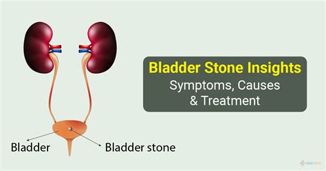 Bladder Stones | Symptoms, Causes, Treatment and Diagnosis, Risks