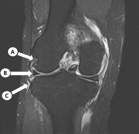 The normal appearance of the ALL ligament is shown in the MRI image ...