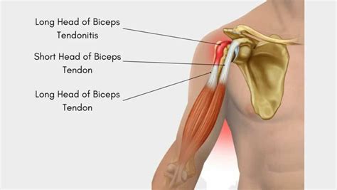 Long Head of Biceps Tendonitis: Symptoms and Exercises for LHB