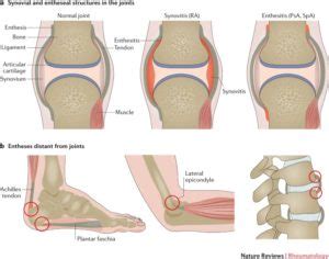 The Clinical Importance of Enthesitis | Key Information and Features of Enthesopathy ...