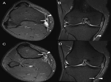 Stener-Like Lesion of the Superficial Medial Collateral Liga ...