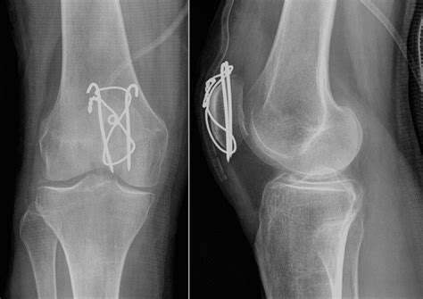 Patella Fracture - TeachMeSurgery