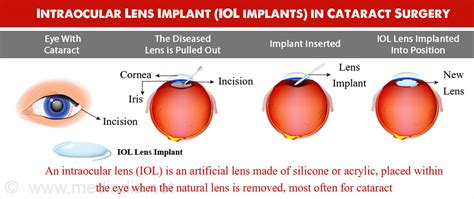 Intraocular Lens Implants (IOL) - Types, Procedure, Recovery ...