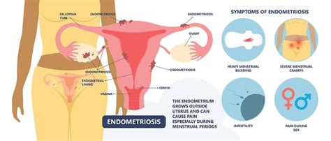 Dysmenorrhea