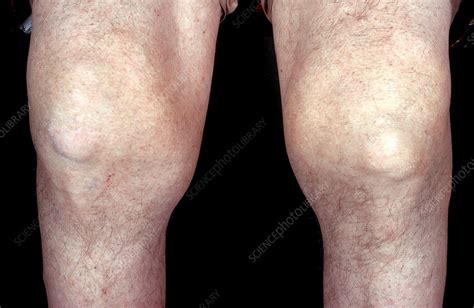 Severe Gout, Knees - Stock Image - C050/4420 - Science Photo Library