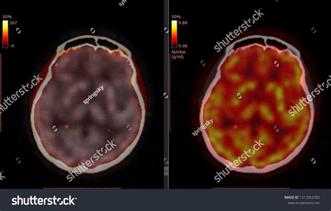 Pet Ct Scan Human Brain Axial Stock Photo 1317052703 | Shutterstock