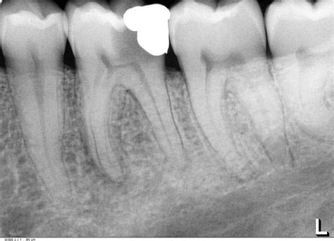 A tooth with a Vital Pulp and Apical Lucencies! | the endospot