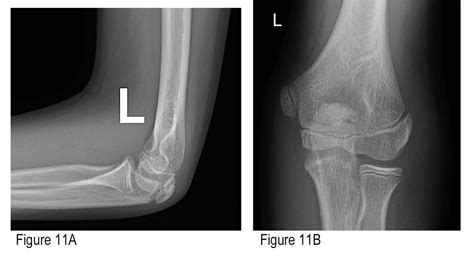 Comment éviter de manquer une fracture du coude pédiatrique | Krediblog