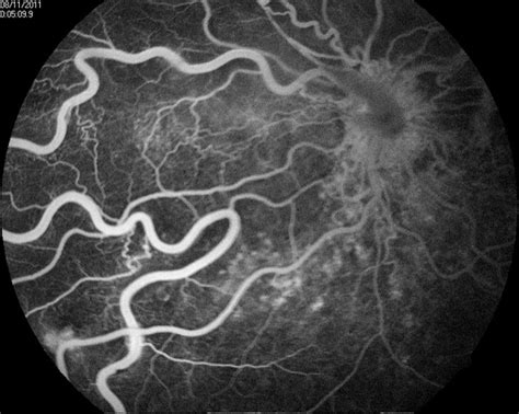 Racemose Hemangioma and Retinal Vein Occlusion - Retina Image Bank