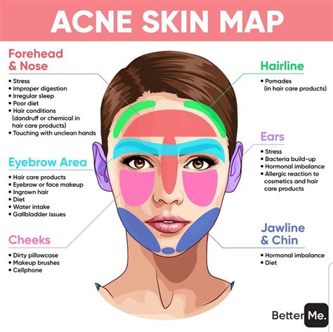 Face Map For Acne Acne Mapping Face Mapping Face Acne | The Best Porn ...