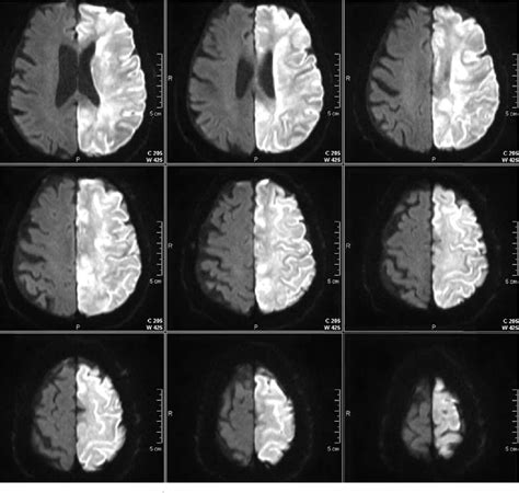 Figure 2 from Advanced imaging in acute ischemic stroke. | Semantic Scholar