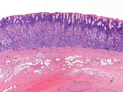 Atrophic Gastritis Histology