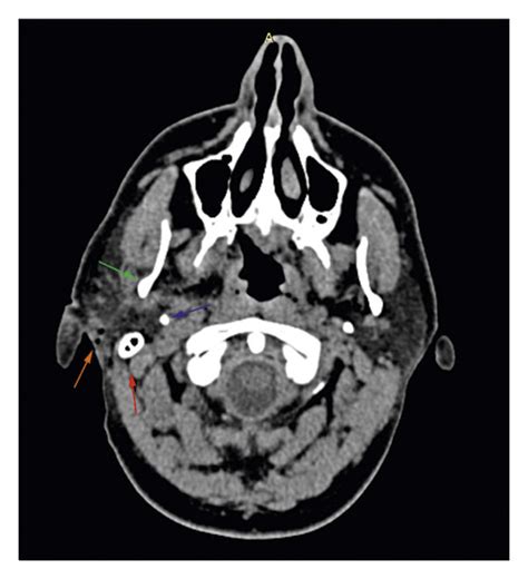 CT scan showing a mastoid tip (red arrow), styloid process (blue... | Download Scientific Diagram