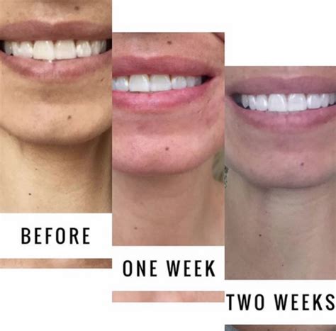 Snow Teeth Whitening Reviews (Before/After Photos)