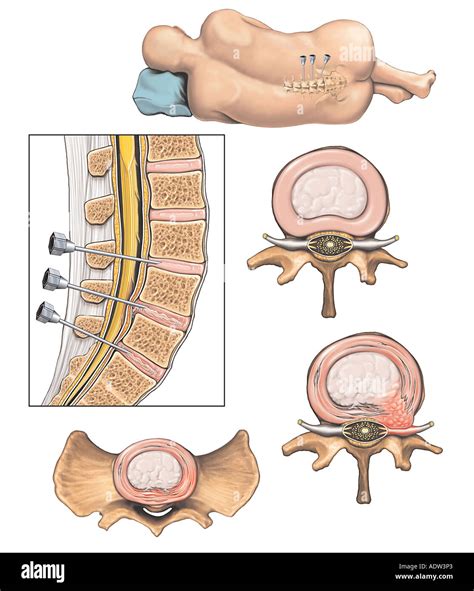 Herniations hi-res stock photography and images - Alamy