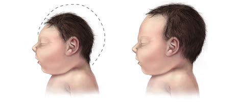 Microcephaly - Causes, Symptoms, Diagnosis, Prognosis, Treatment