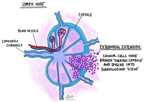 Extranodal extension (ENE) - Pathology dictionary - MyPathologyReport.ca