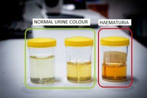 BLOOD IN URINE: BUT WHERE FROM? - All Things Kidney ~ Official