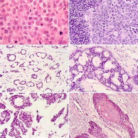 Breast: Ductal carcinoma