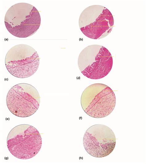 Globulomaxillary Cyst Histology