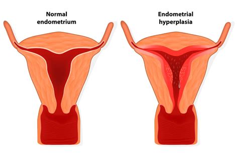 Endometrial Hyperplasia | Familydoctor.org - Primenewsprint