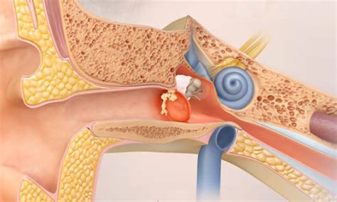 What is cholesteatoma? - Knox Audiology - Knox Hearing Clinics