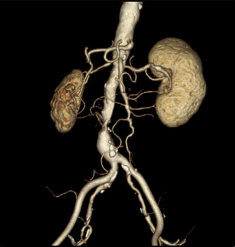 Endovascular Aortic Repair for Isolated Infrarenal Aortic Stenosis - Annals of Vascular Surgery